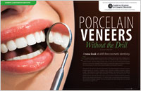 no-prep procelain veneers