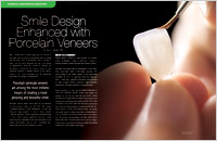 porcelain veneers