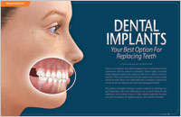 dental implants