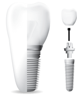 Dental implant graphic showing the separate parts.