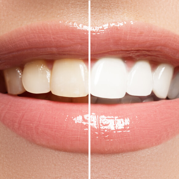 Before and after whitening results.